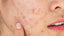 Acne Fite, sun protection, blackheads,