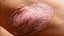 Effective management strategies for quick psoriasis relief