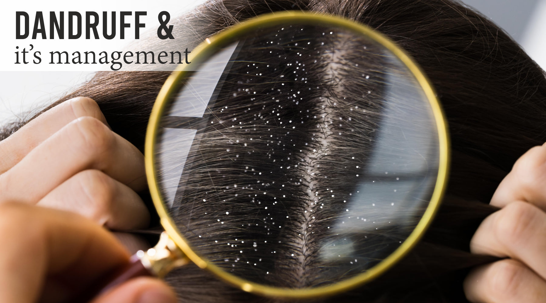 Dandruff and its management